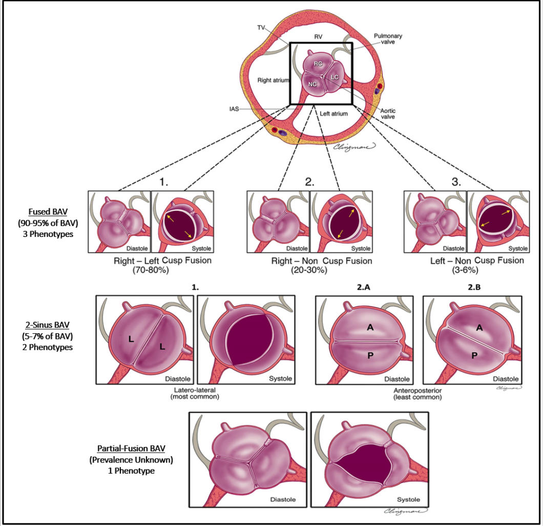 Diagrama dos fenótipos da valva aórtica bicúspide